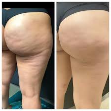 Cellulite Gone: Non Invasive Root Cause Treatment for Smooth Skin!